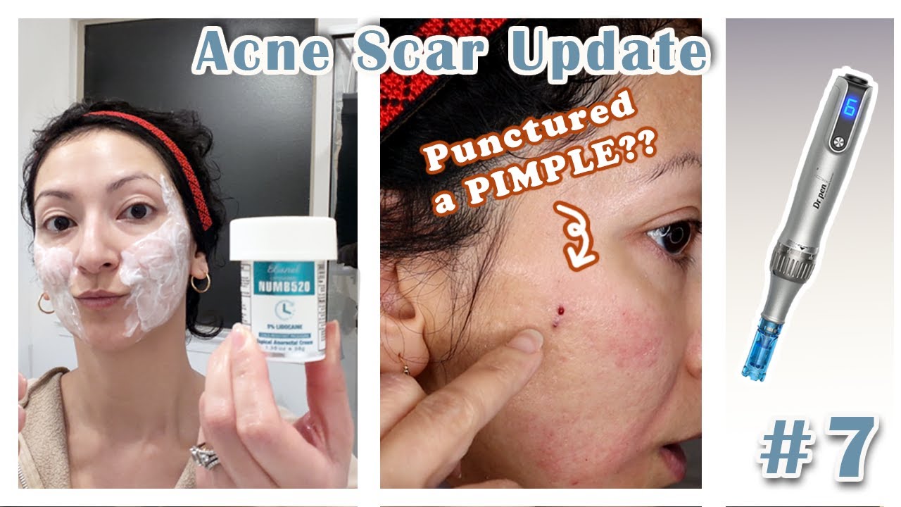 Обновление №7 по микронидлингу для лечения рубцов от угревой сыпи | Dr Pen 2,5 мм