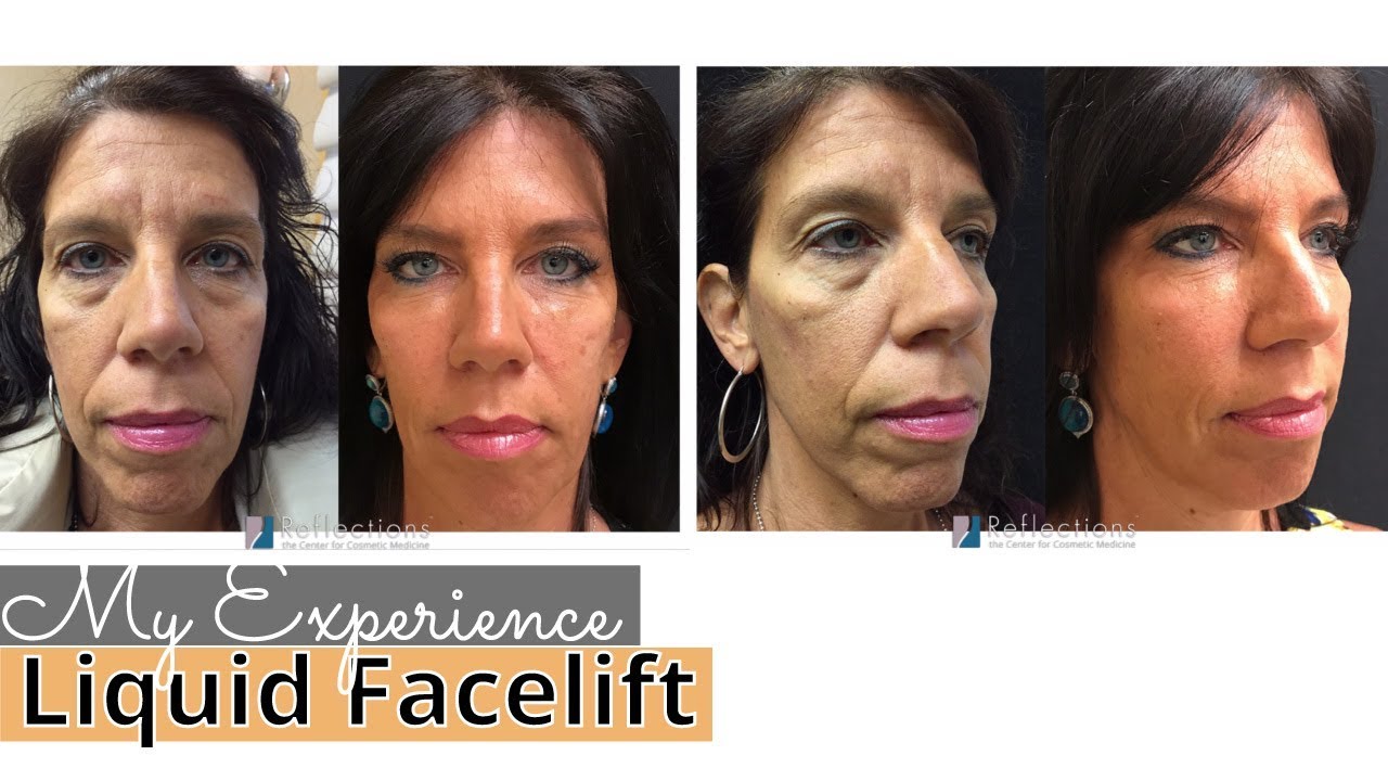 My Liquid Facelift Experience [ #Botox & #Fillers for #50+Women ] #LiquidFacelift