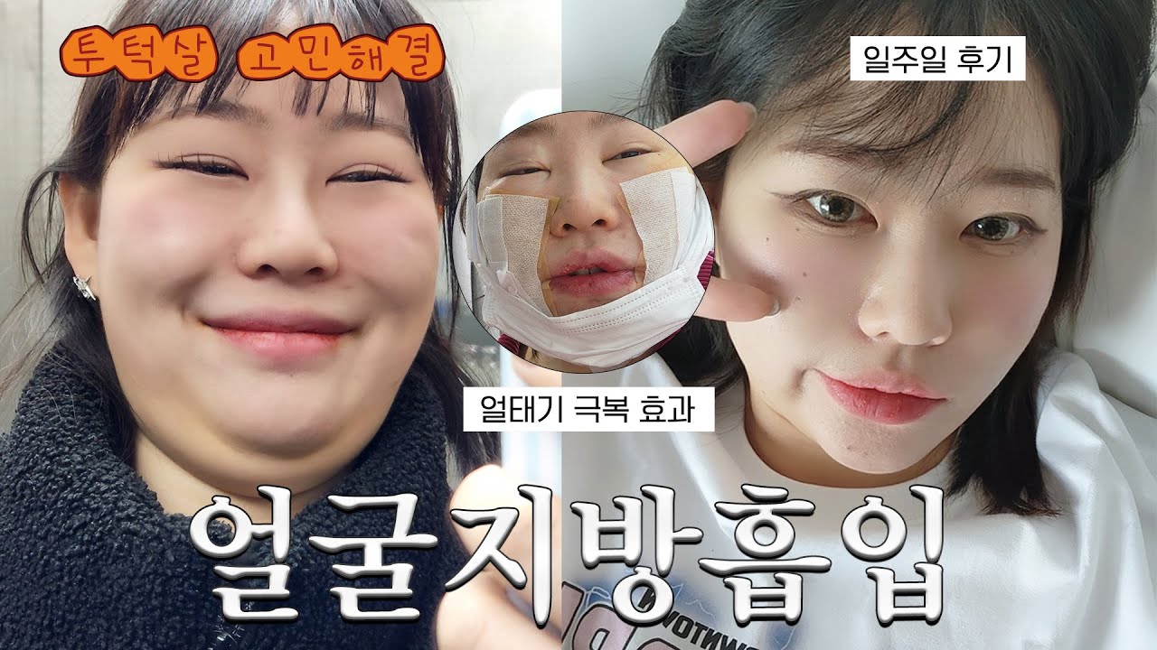 얼굴지방흡입으로 투턱살 조지고 왔습니다😎 고도비만녀 77kg의 일주일 후기!