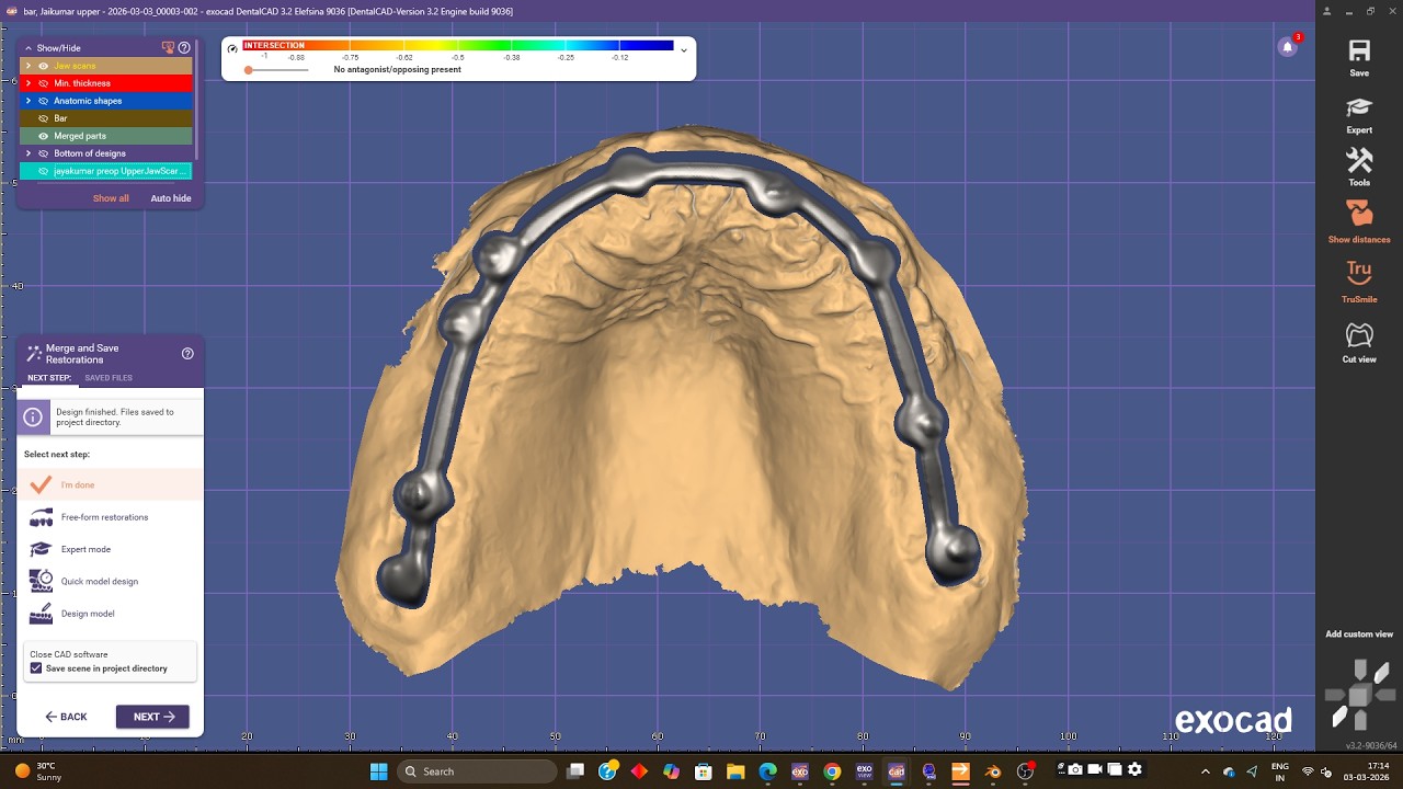 Cement  retained bar designing for upper all on x in Exocad- best laser -chennai