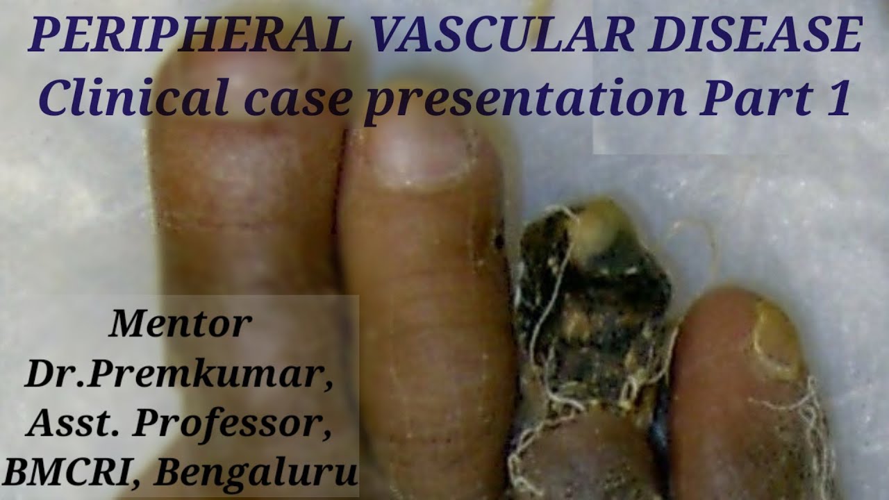 PERIPHERAL VASCULAR DISEASE Clinical case presentation Part 1