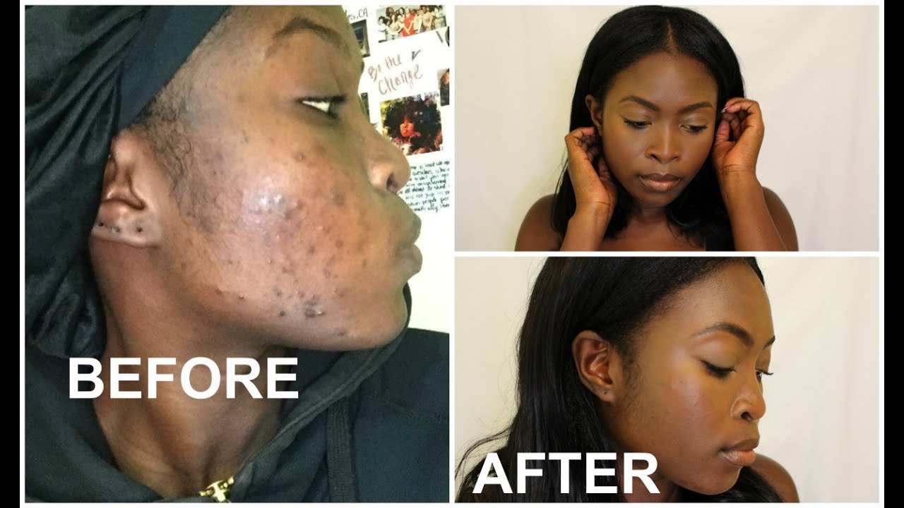 HOW TO CLEAR DARK MARKS FAST ! 👍  DETAILED SKIN ROUTINE.
