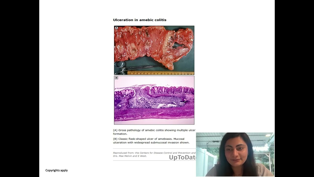 Zooming through ID with Dr. Gopal: Entamoeba histolytica and Liver abscess