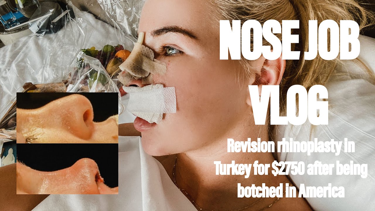 MY NOSE JOB (REVISION RHINOPLASTY) EXPERIENCE IN TURKEY // botched nose and traveling alone