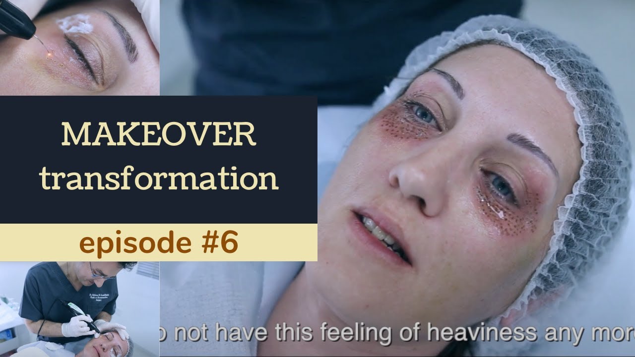 EYE LIFT PLEXR. Makeover transformation. Ep 6.