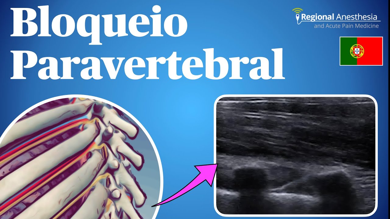 Bloqueio Paravertebral