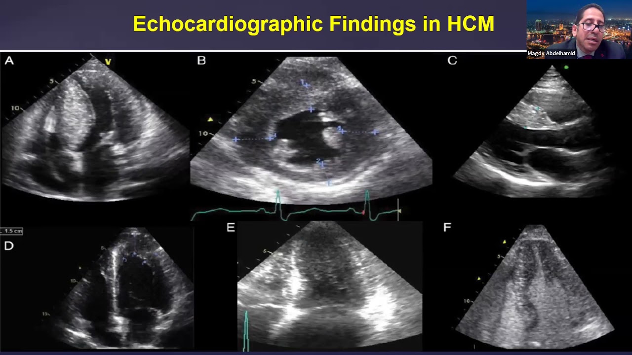 7- Hypertrophic cardiomyopathy - Prof. Magdy abdelhamid