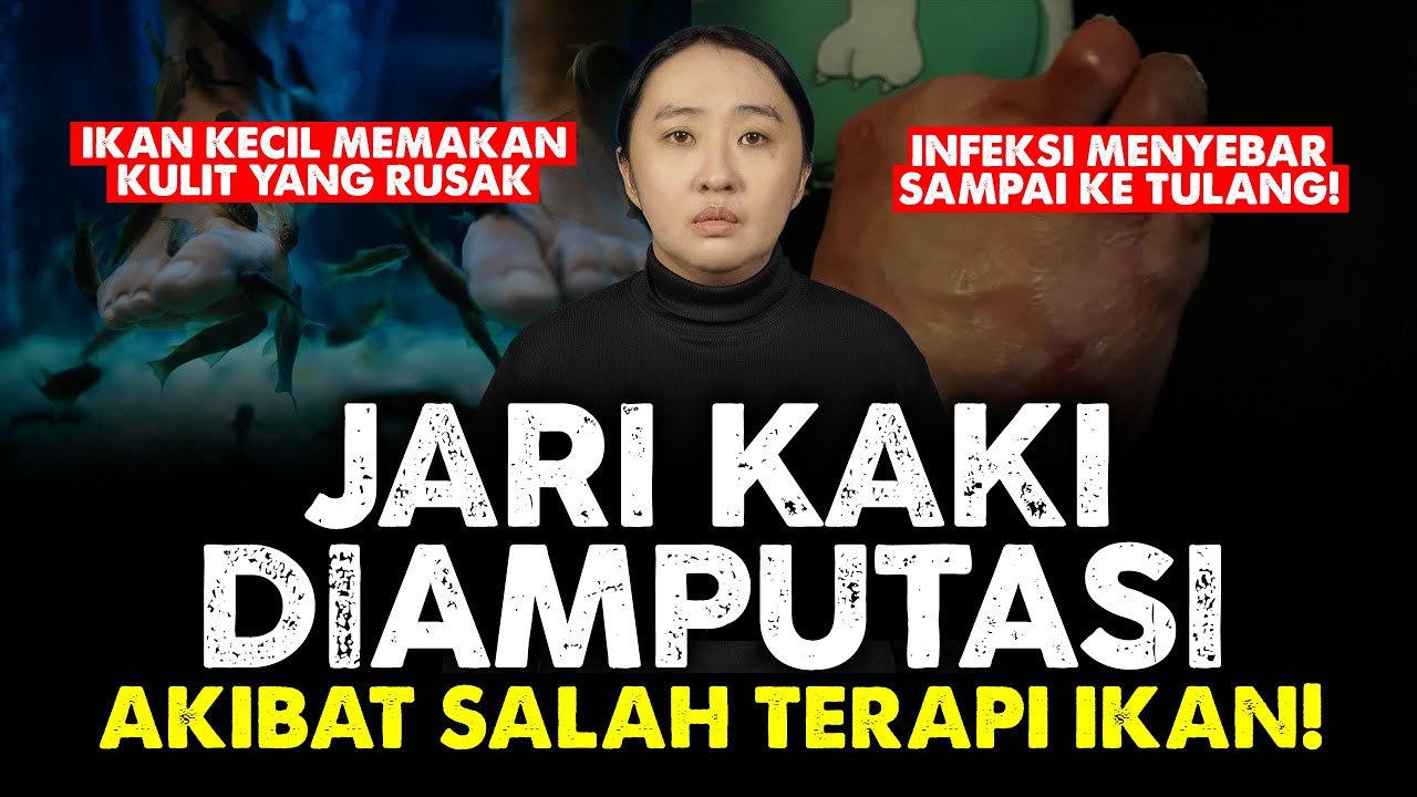 JARI KAKI DI AMPUTASI AKIBAT SALAH TERAPI❗️