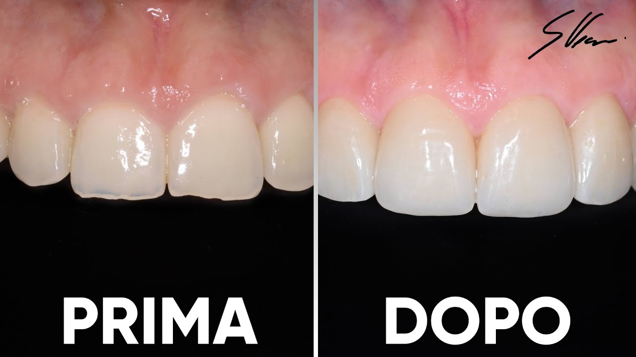 Denti consumati e incisivi troppo corti? Ecco la soluzione