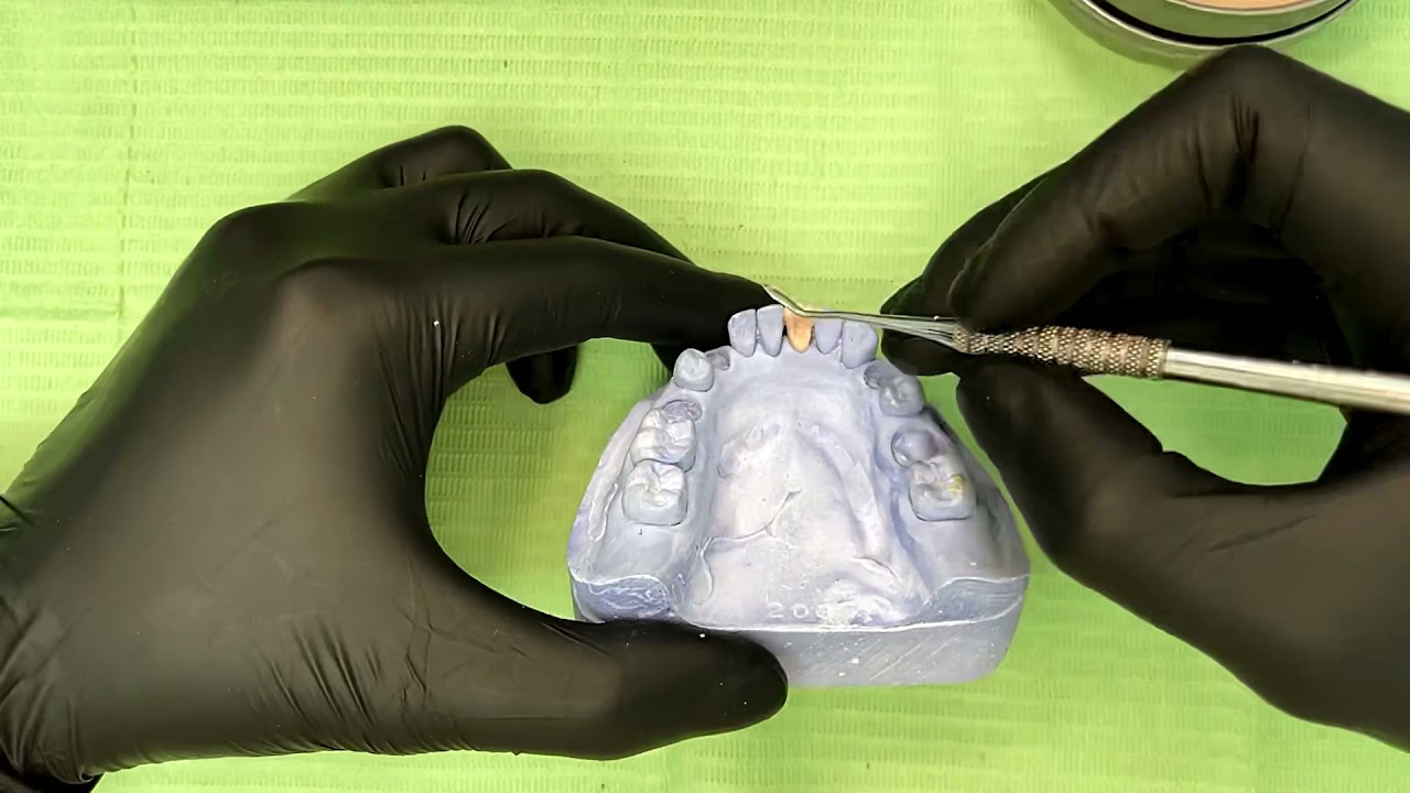 Encerado incisivo central mandibular permanente / Permanent mandibular central incisor wax-up.