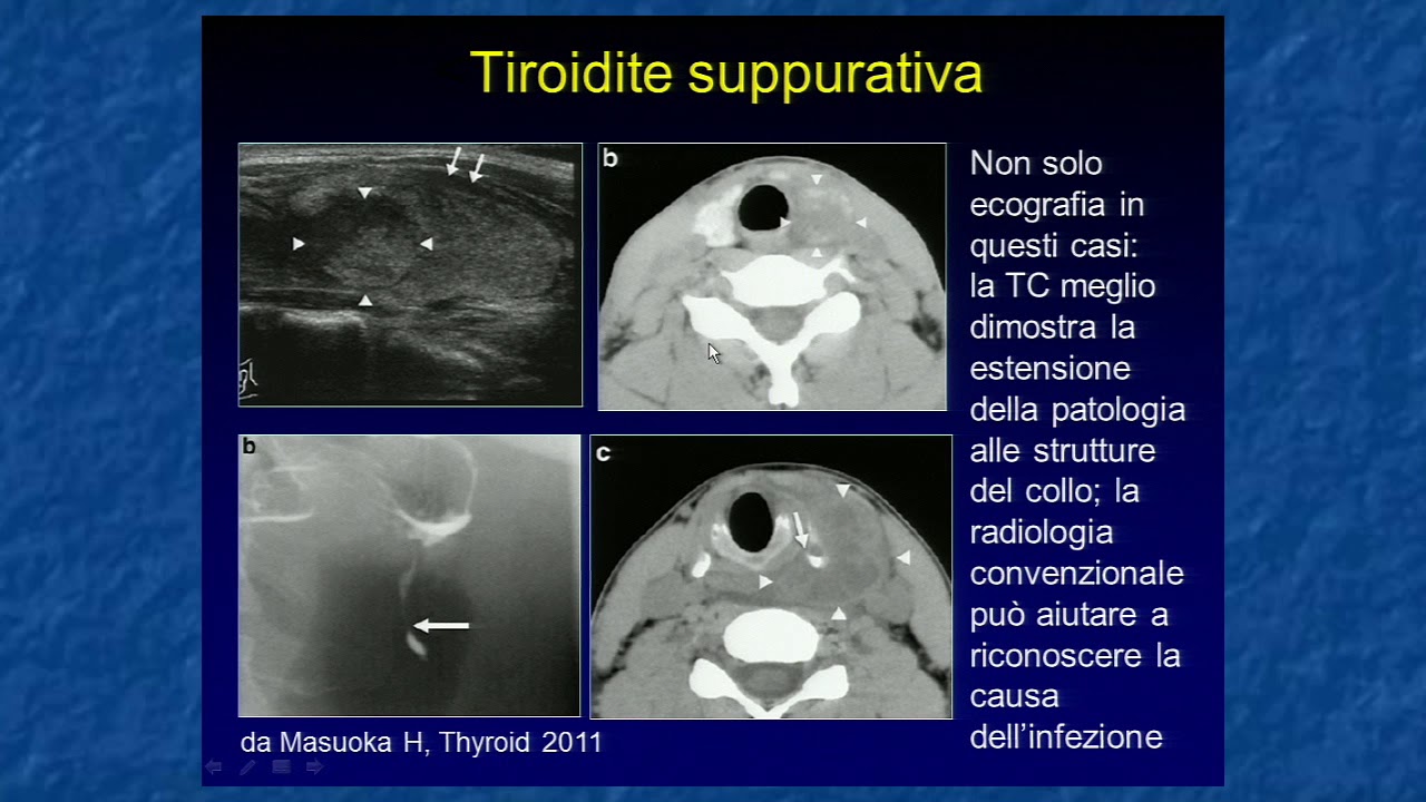 18 Tiroiditi acute e croniche. Lorenzo Derchi