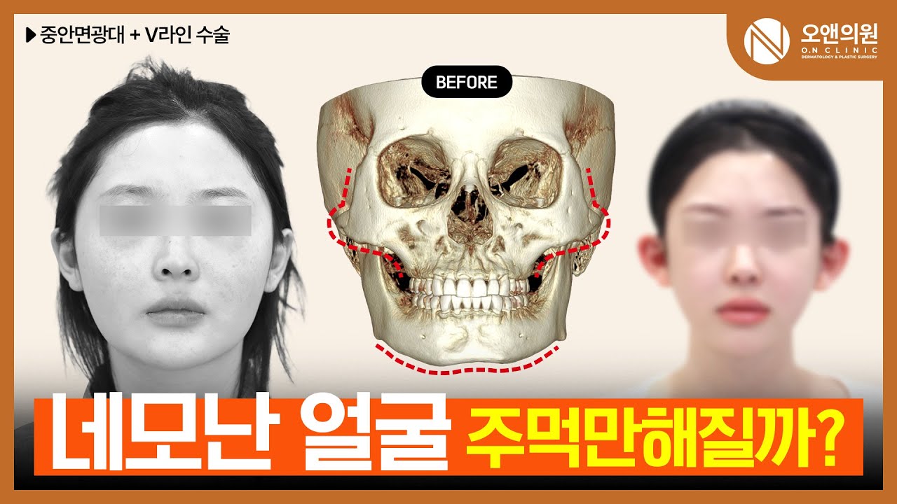 네모난 얼굴, 주먹만해질까? | (JPN/CN/ENG SUB) #윤곽 #중안면축소술 #광대비대칭 #성형