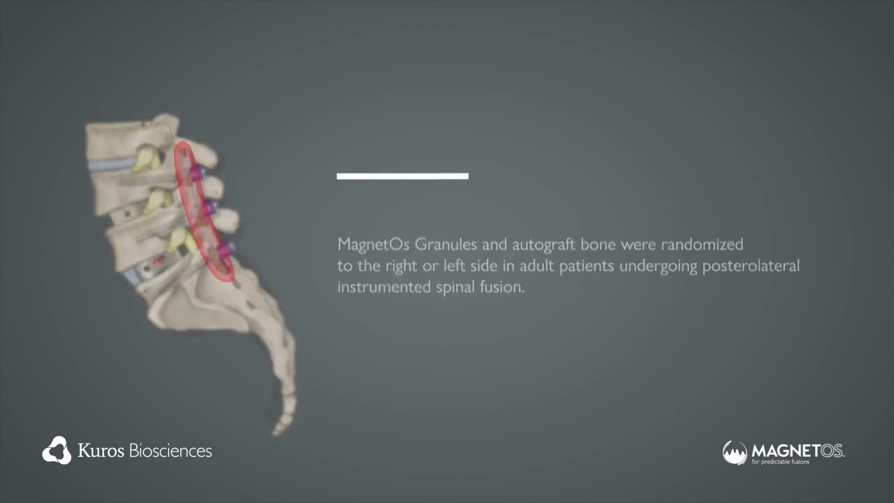Favorable Results of MagnetOs as Standalone Alternative to Autograft in a Level 1 Clinical Trial