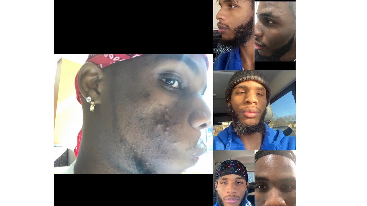HOW I CLEARED MY ACNE AND HYPERPIGMENTATION!!! (UNBELIEVABLE)