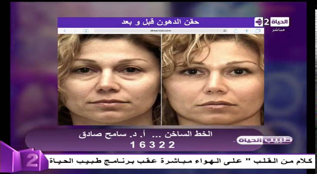 طبيب الحياة - بالصور حقن الدهون في الوجه - د. سامح صادق - أستاذ جرحات التجميل