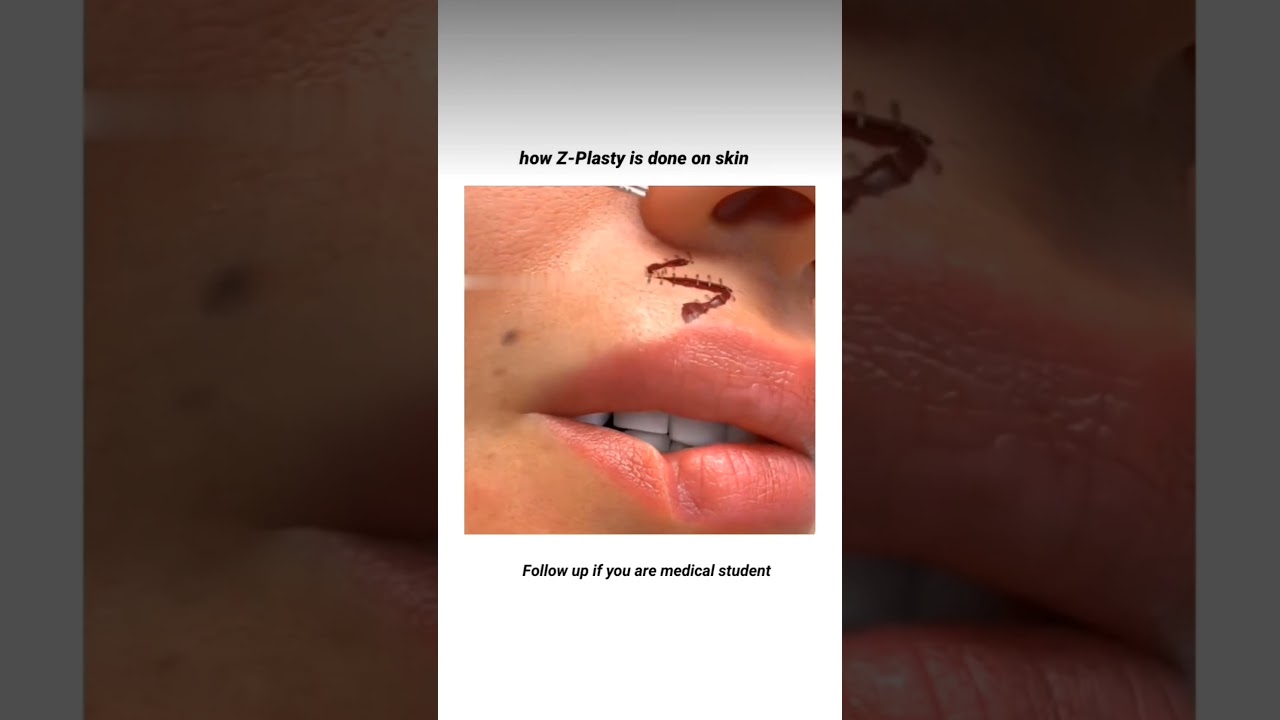 Z plasty done on skin