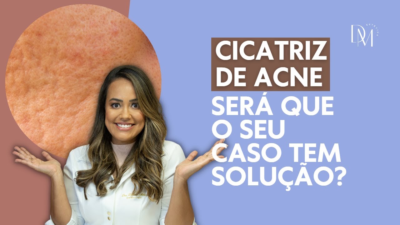 CICATRIZ DE ACNE: MICROAGULHAMENTO RESOLVE? MEU CASO TEM SOLUÇÃO? SAIBA TUDO NESTE VÍDEO!