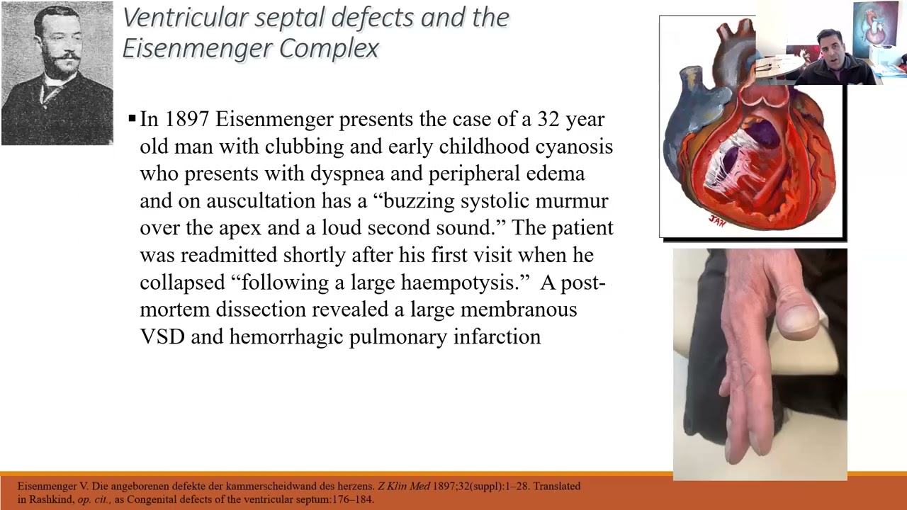 Defying the Odds and Challenging the Status Quo - The Saga of Adult Congenital Heart Disease