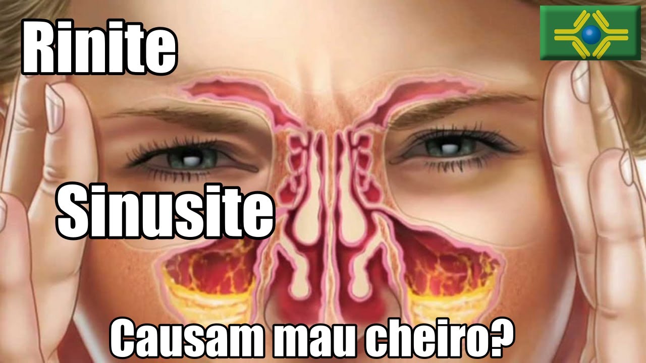 CHEIRO FORTE no nariz quando ataca a RINITE e SINUSITE &eacute; normal? | Vacina Covid
