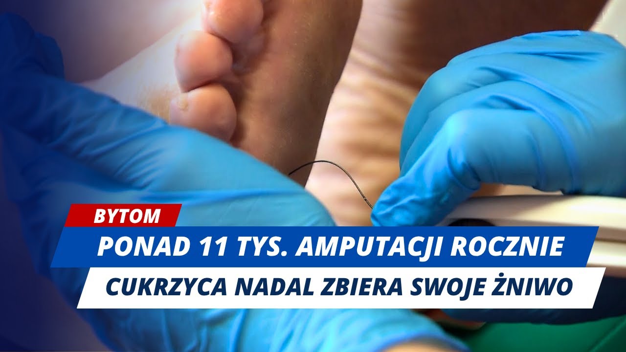 PONAD 11 TYS. AMPUTACJI ROCZNIE! JAK WALCZYĆ Z CUKRZYCĄ?
