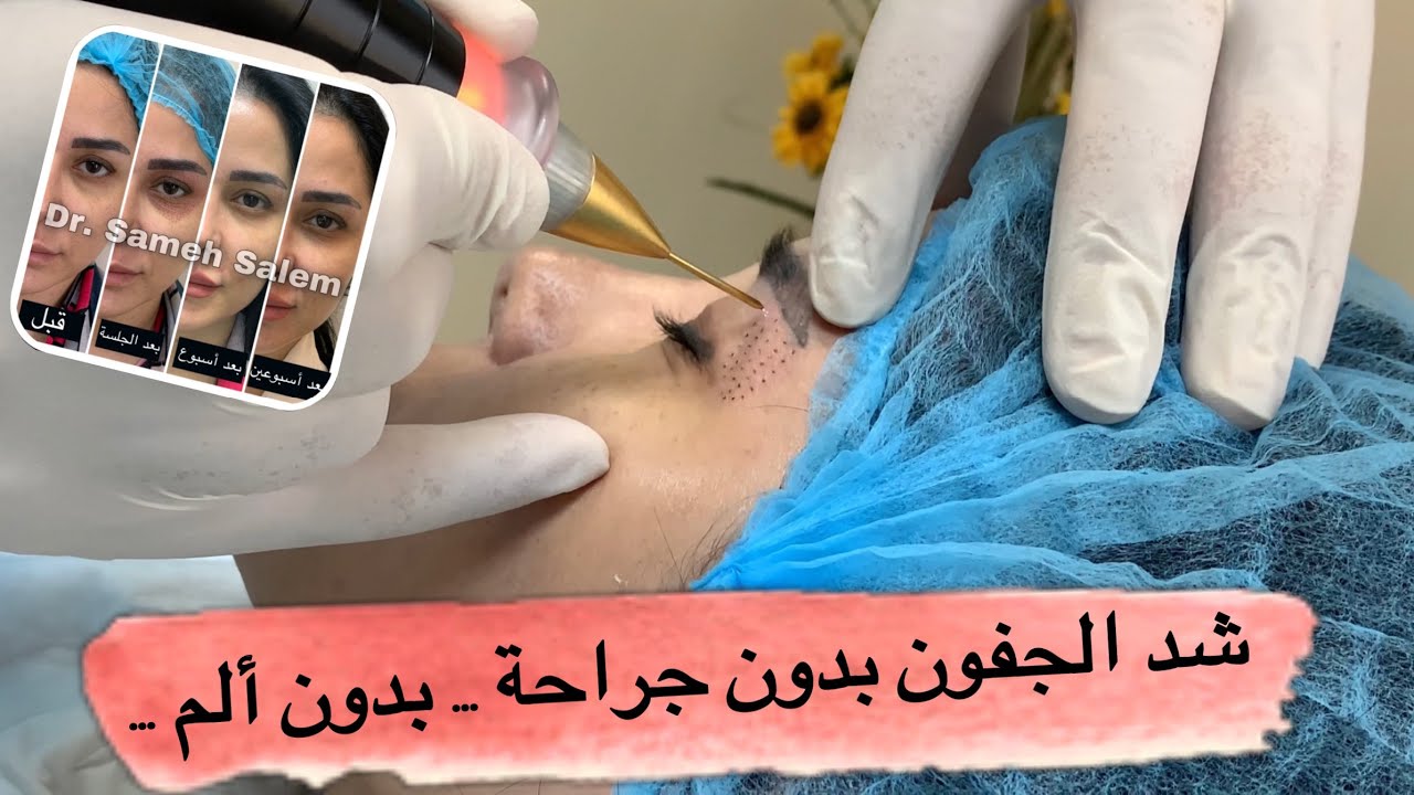 بلازما جِت ... شد الجفن بدون جراحة .... بدون ألم ... | دكتور سامح سالم