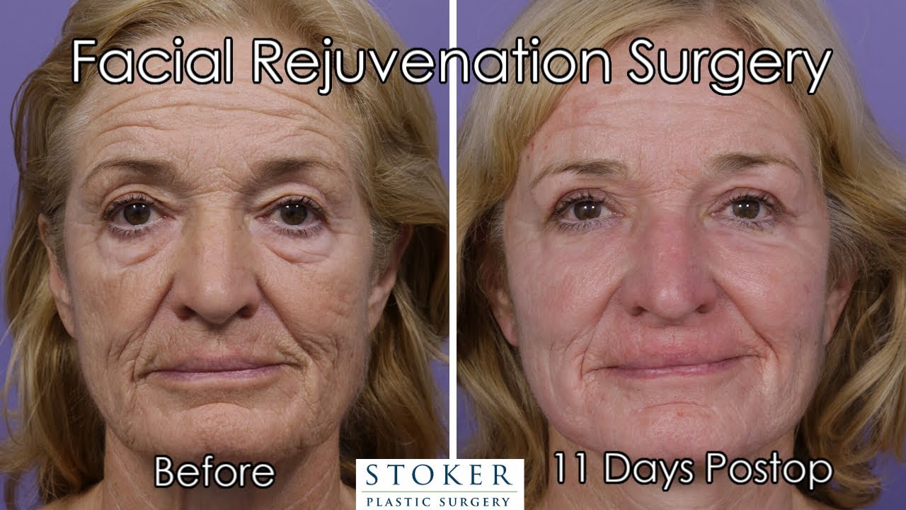 Facelift Los Angeles: One of the best plastic surgeons in Los Angeles Reveals Results 7 Days Postop