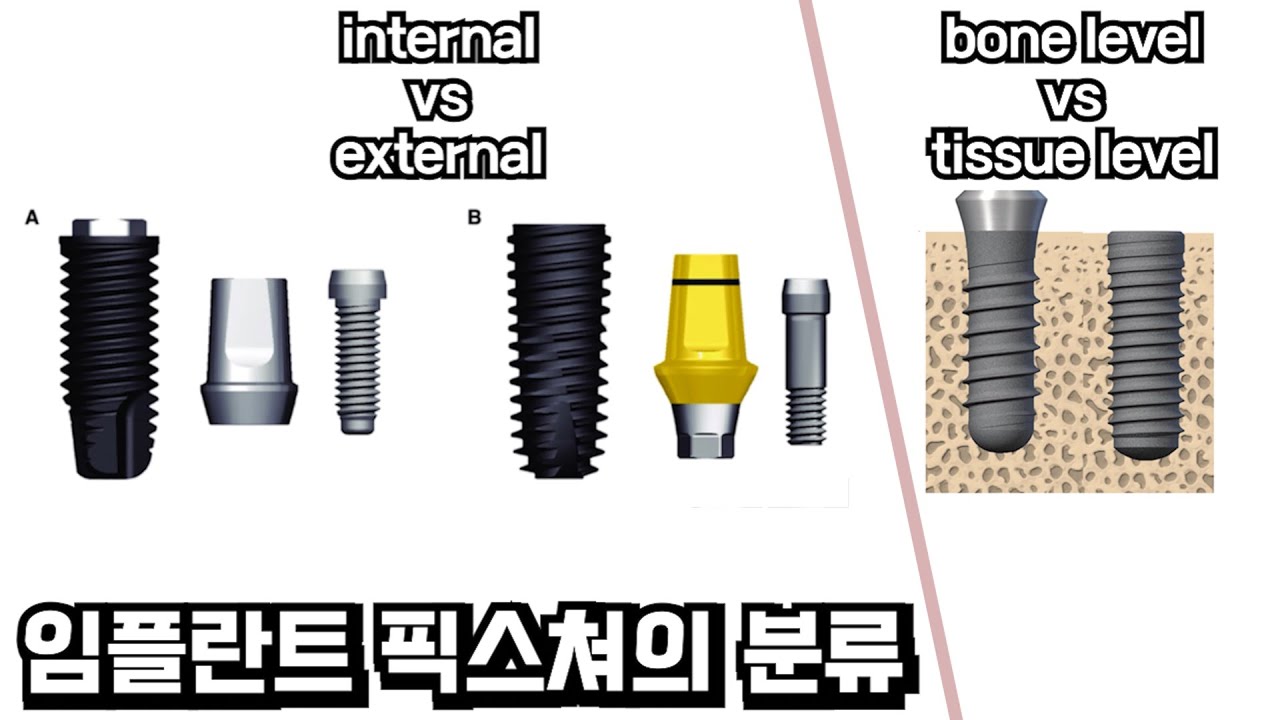 임플란트 픽스쳐의 분류 - internal, external, bone level, tissue level