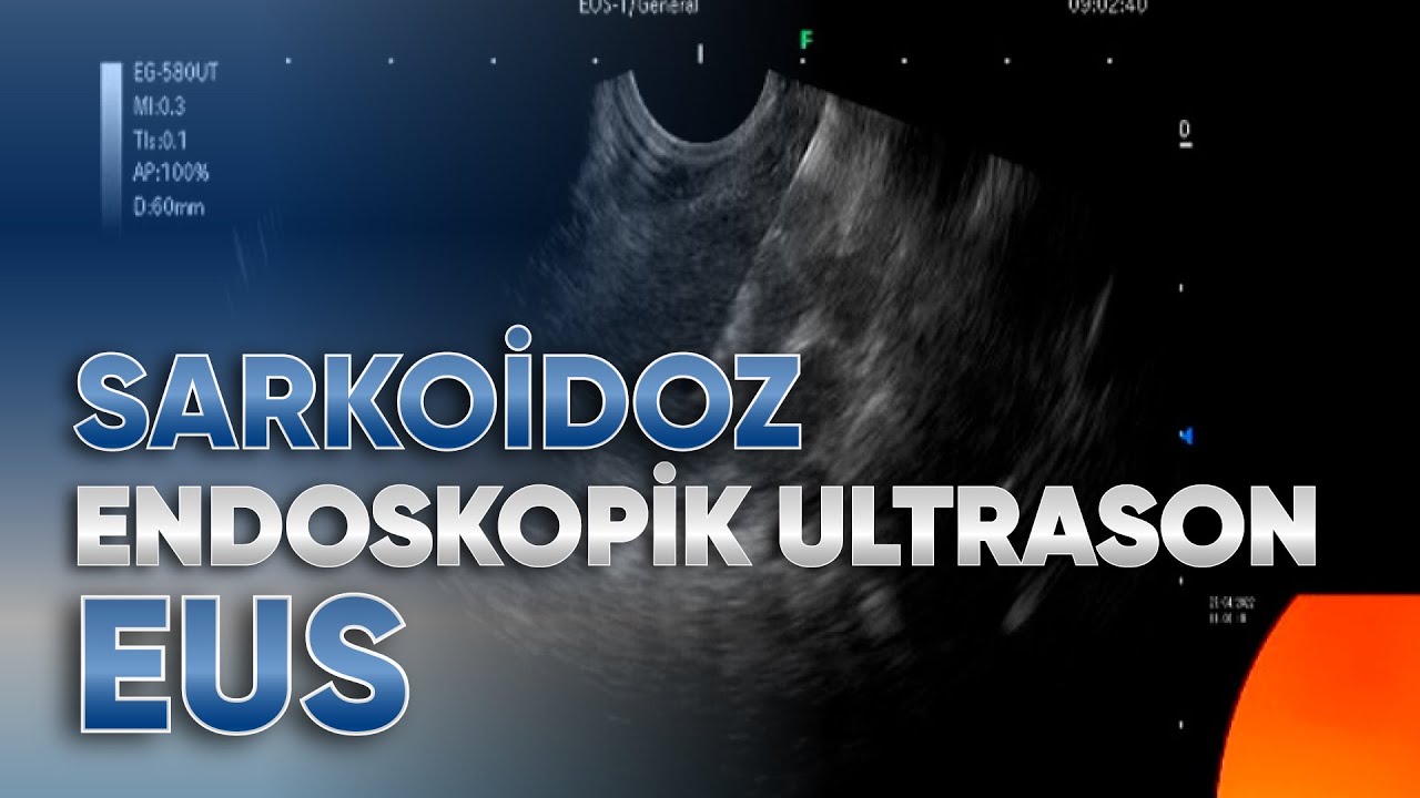 Mediastinal kitlelerde endoskopik ultrason ile FNA biyopsi alınması