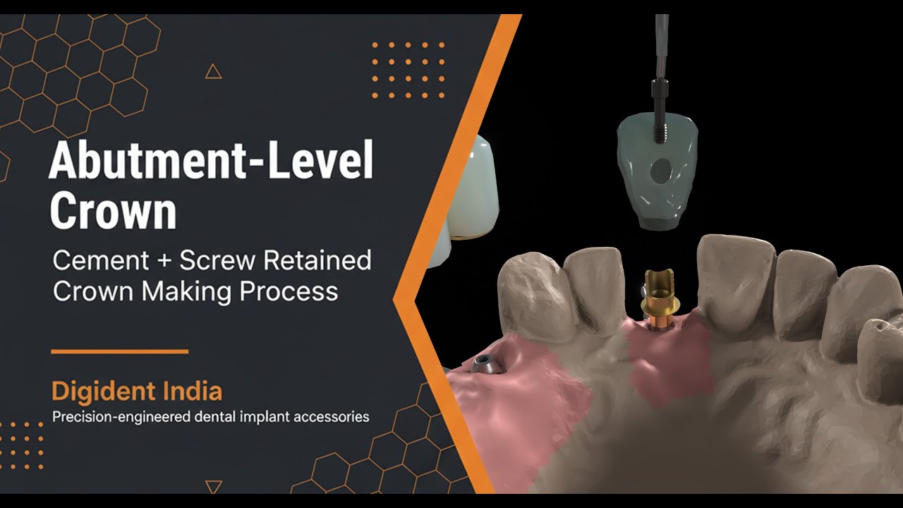 Abutment-Level Crown | Cement + Screw Retained Crown Making Process | Digident India