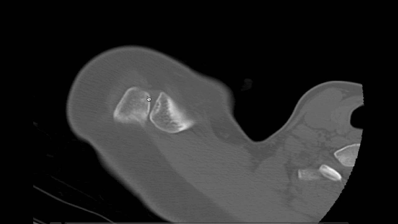Anatomía CT hombro