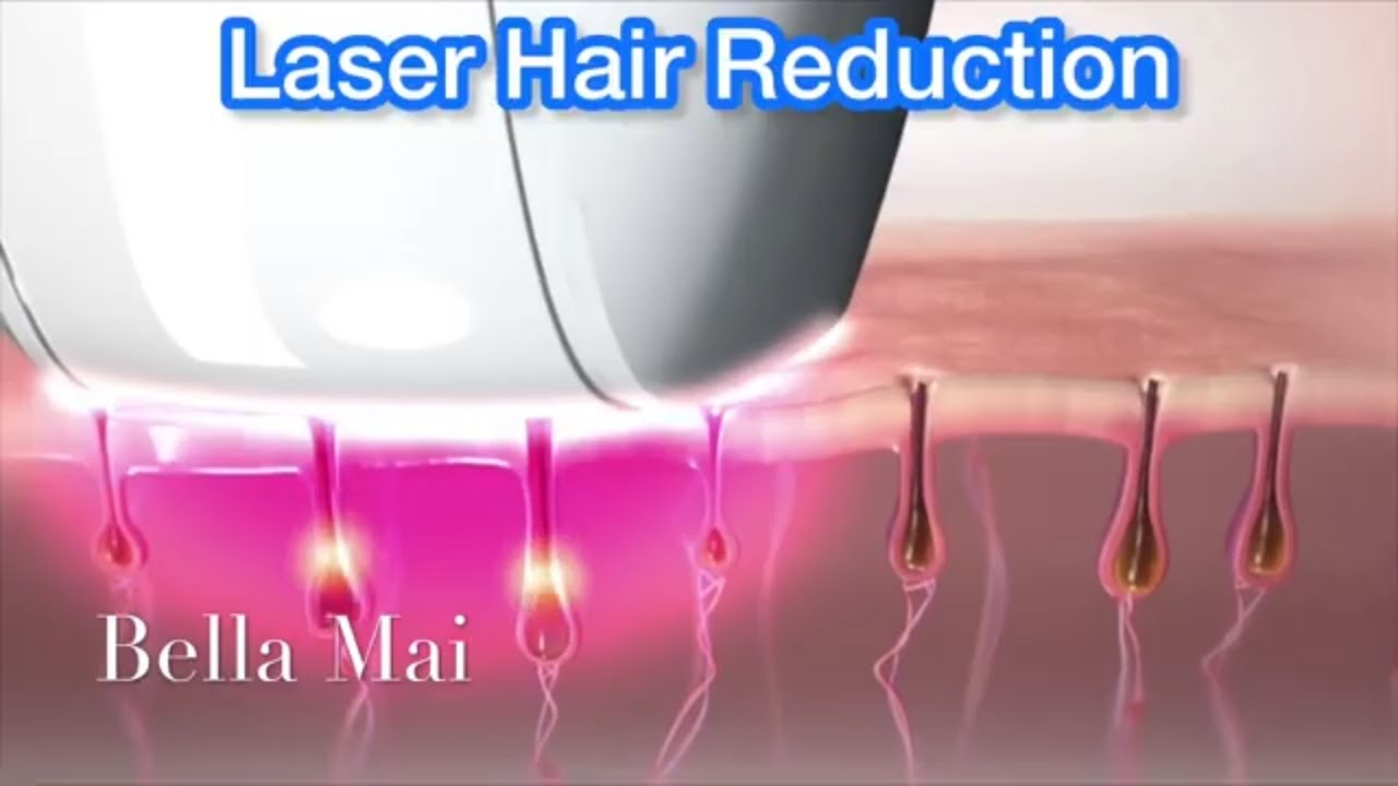 IPL/SHR/DIODE Laser Hair Removal: How Does It Work?