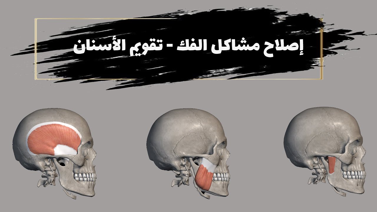 #تقويم_الاسنان - #طقطقة_الفك #طنين في الاذن و #الم الرأس - مشاكل عديدة ومتسبب واحد و حل بسيط جدا