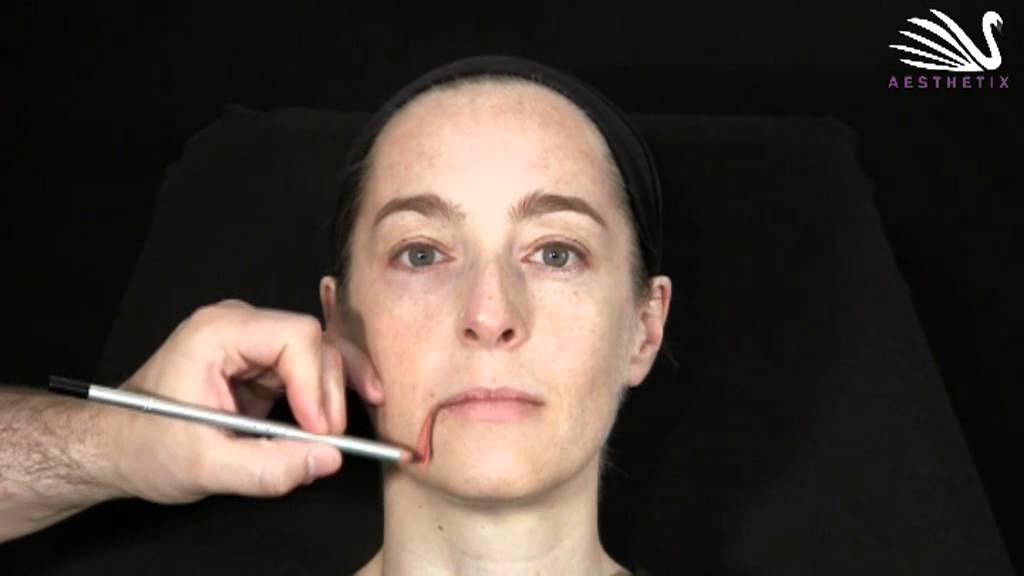 7 - Mundwinkelfalten mit Botox behandeln | Dr. Günther