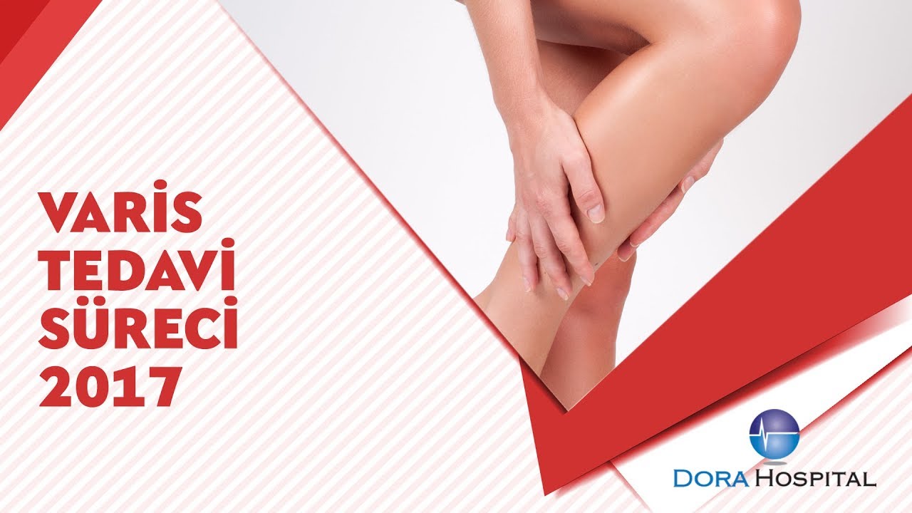 Varis Tedavisi S&uuml;reci - Lazer'le Varis Tedavisi Sonrası ( skleroterapi )