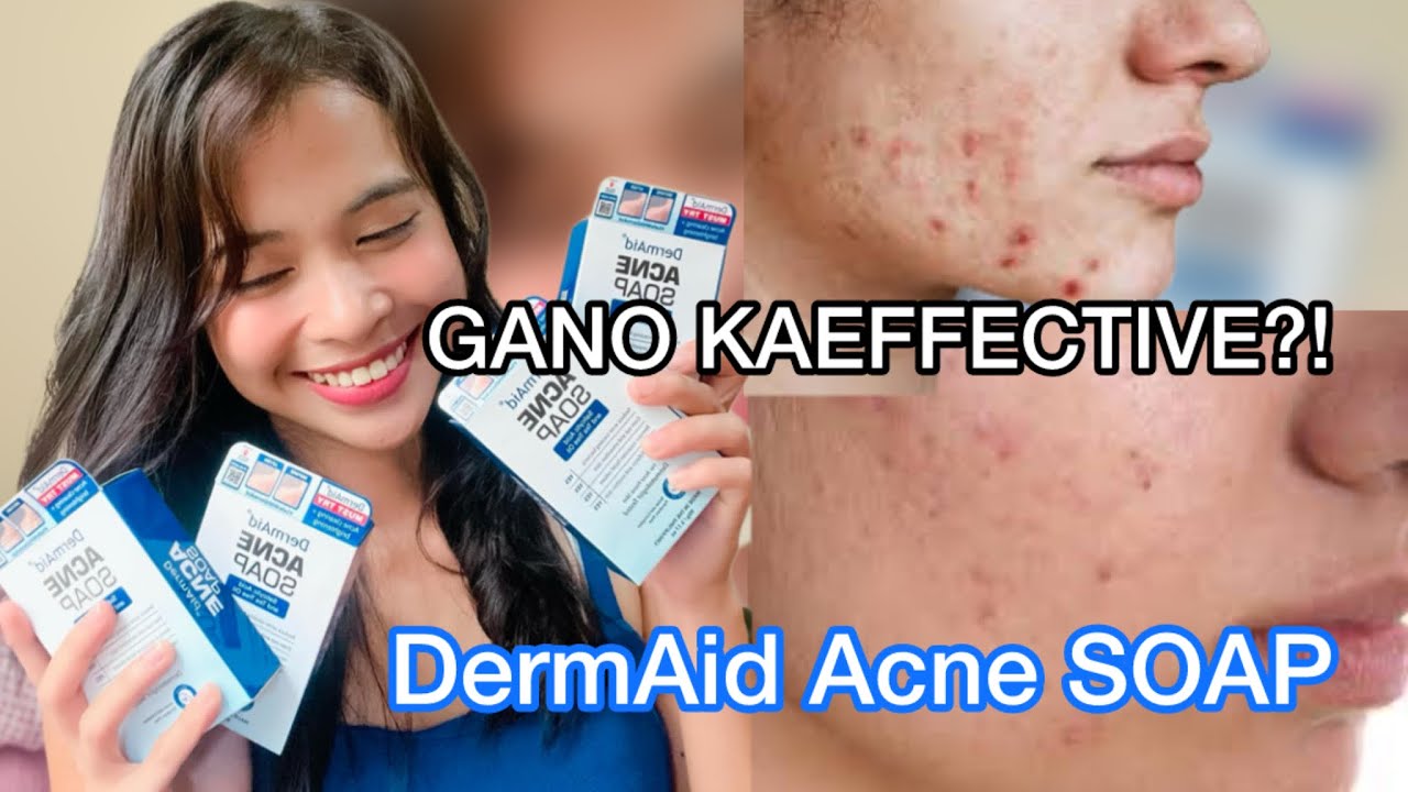 Dermaid Acne Soap REVIEW! (YOU MUST TRY!😱)