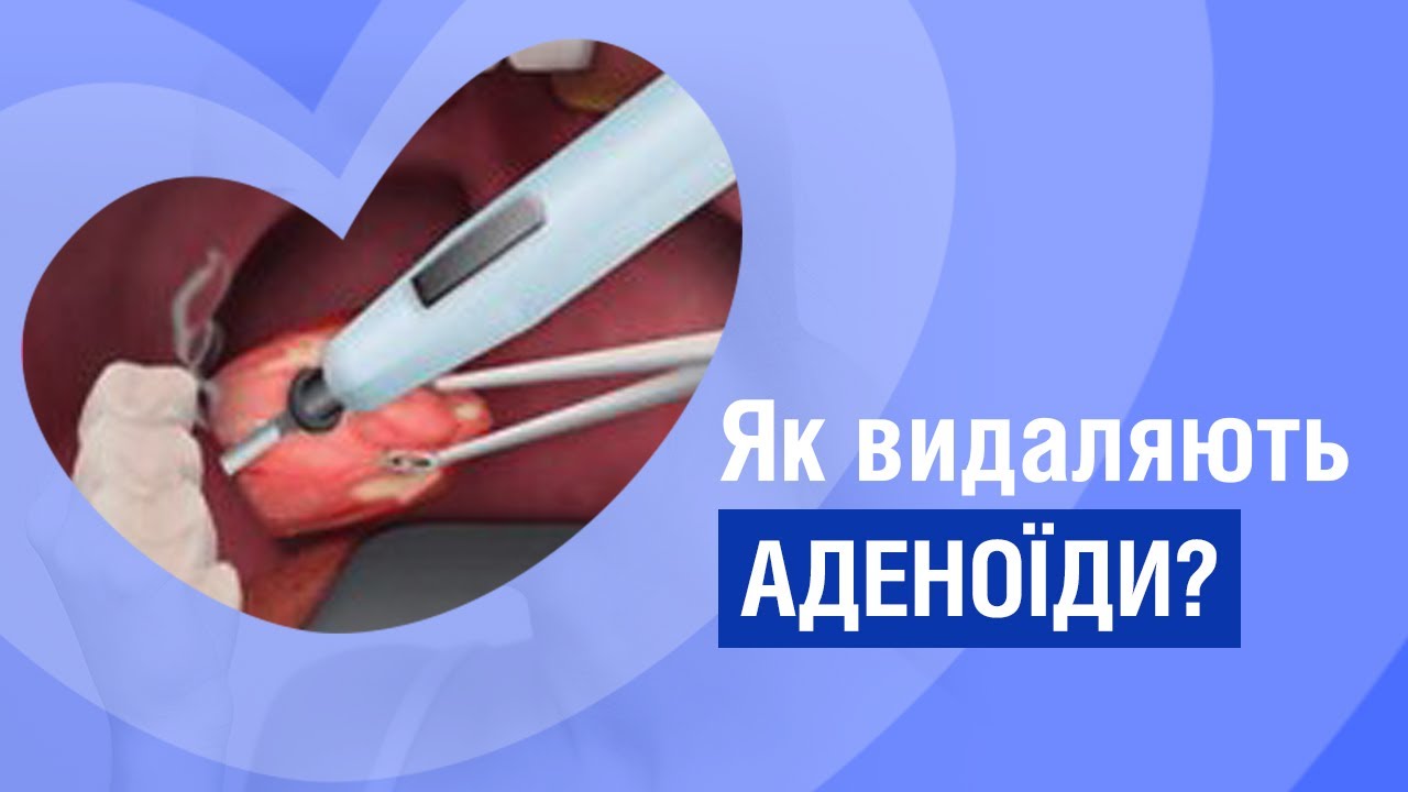 Як правильно видаляти аденоїди? Відповідає лор-хірург