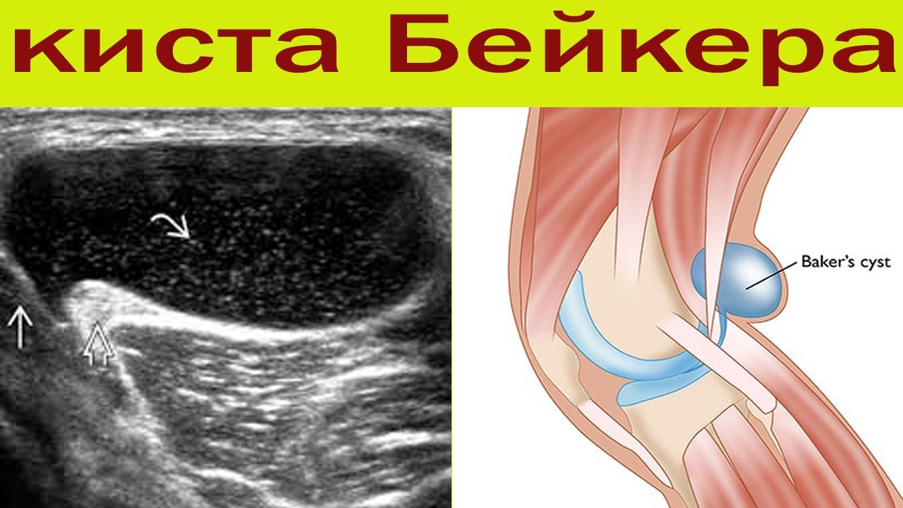 Чем опасна киста Бейкера. Полный обзор заболевания.