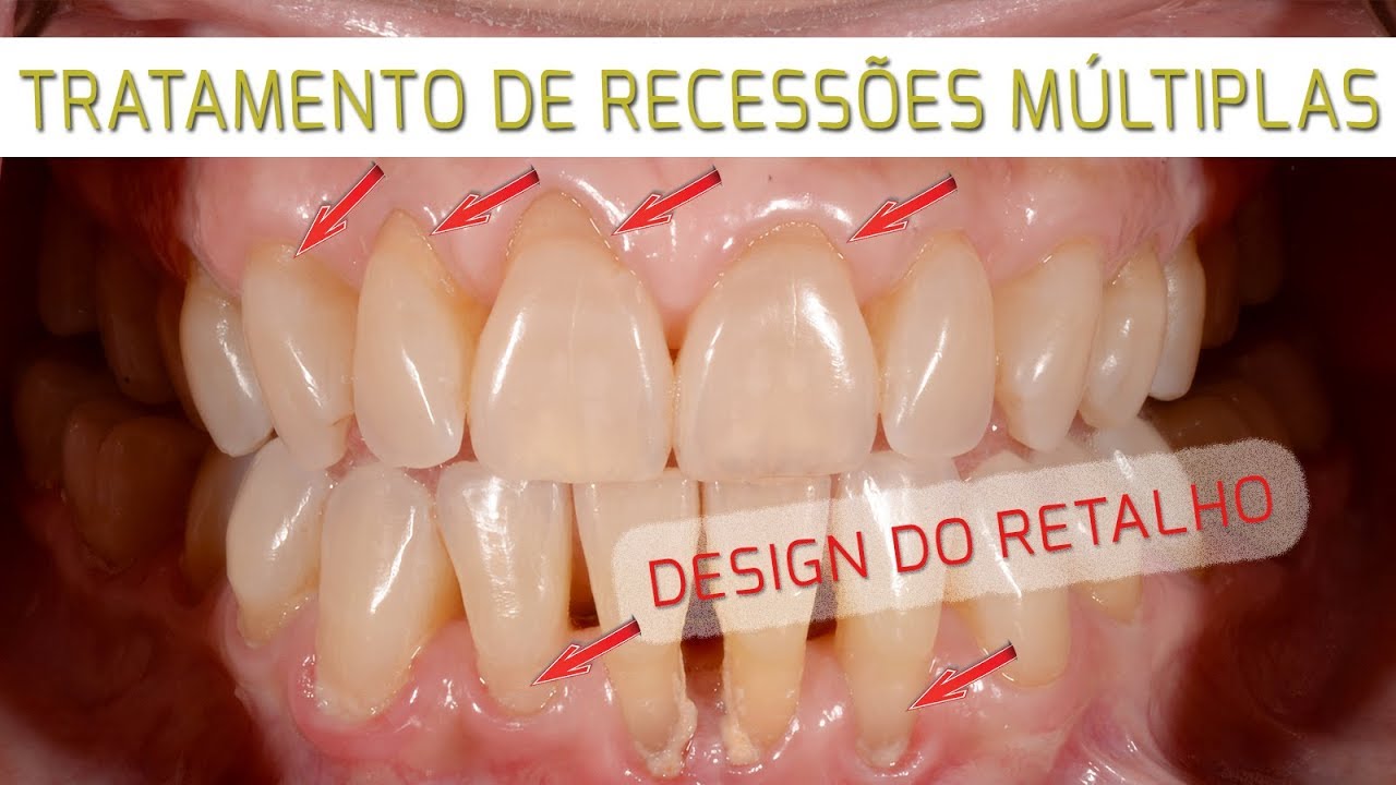 (Ep 33) TRATAMENTO DE RECESSÕES MÚLTIPLAS