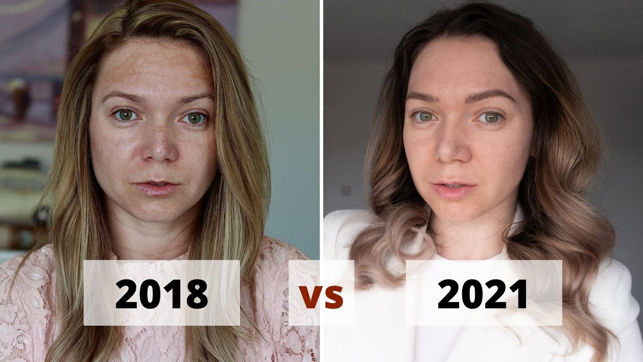 PETELE PIGMENTARE | Cum scapam de ele? UPDATE 2021