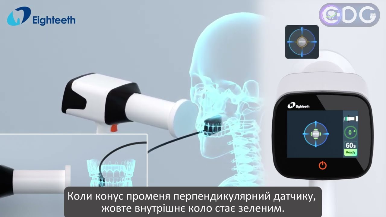Принцип роботи нового портативного рентгена HyperLight-M з технологією M -Tech 🔥
