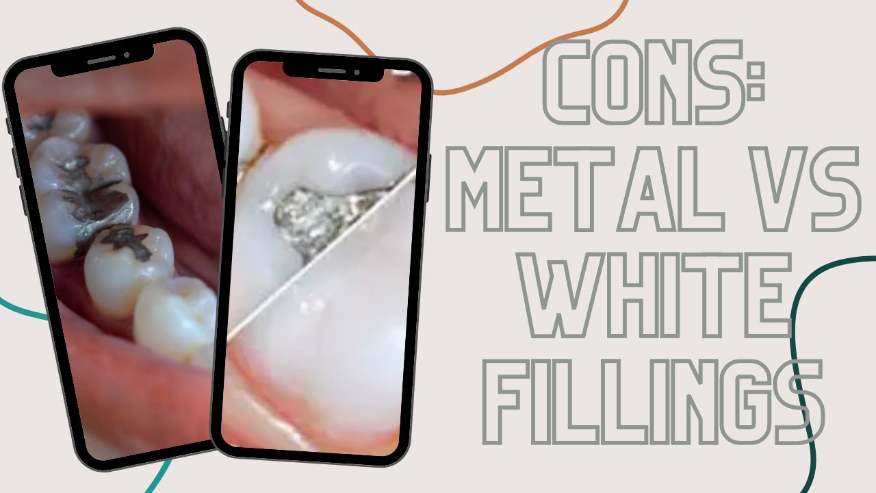 Cons: Metal vs White Fillings #shorts