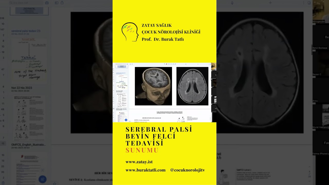 Serebral palsi (beyin felci) güncel tedaviler ve stem cell (kök hücre tedavisi)
