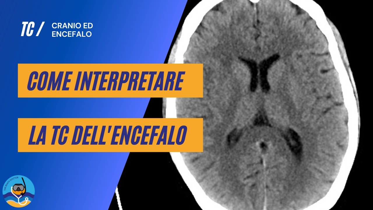 Come interpretare la TC encefalo - parte 3 (parenchima cerebrale, ventricoli ed osso)