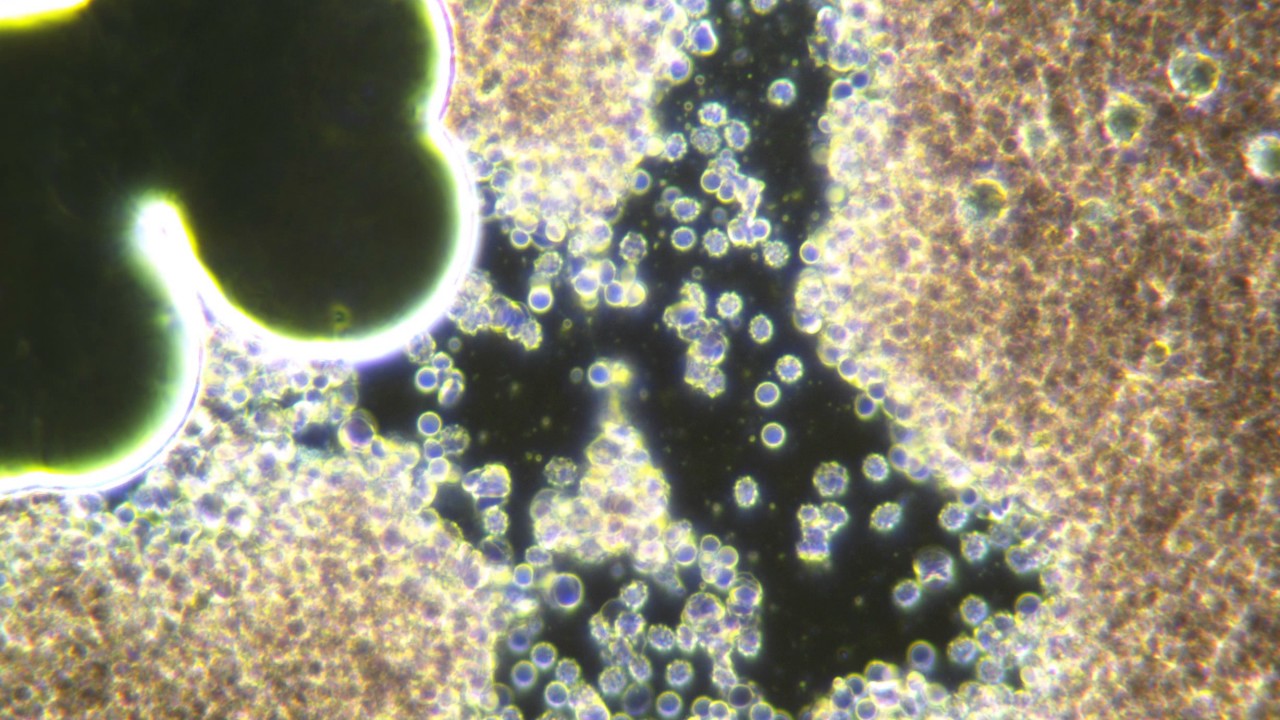 my live blood infection showing Lyme spirochete and co-infections