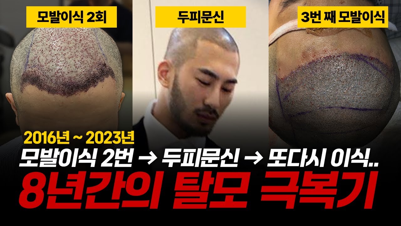 탈모와 싸운 8년의 기록 | 모발이식 2번 → 두피문신 → 또다시 모발이식..