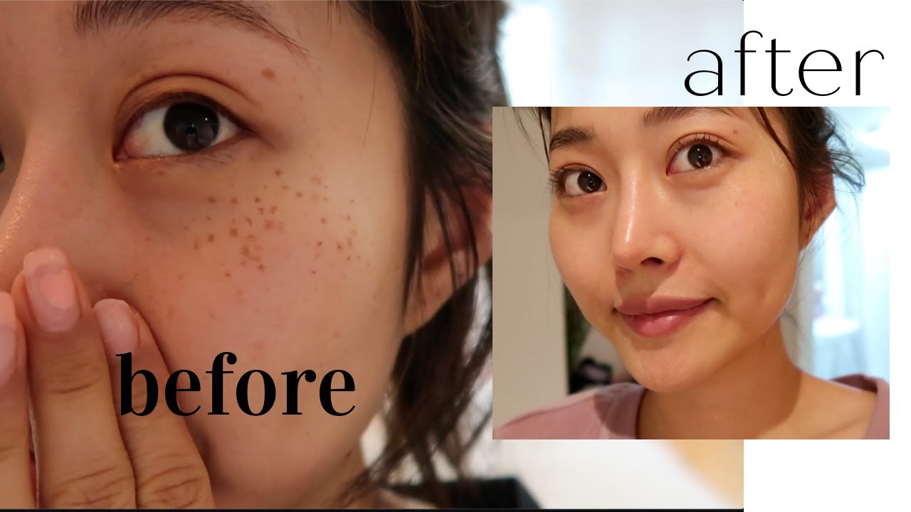 Getting my freckles removed in Korea: full process, price, healing, and tips