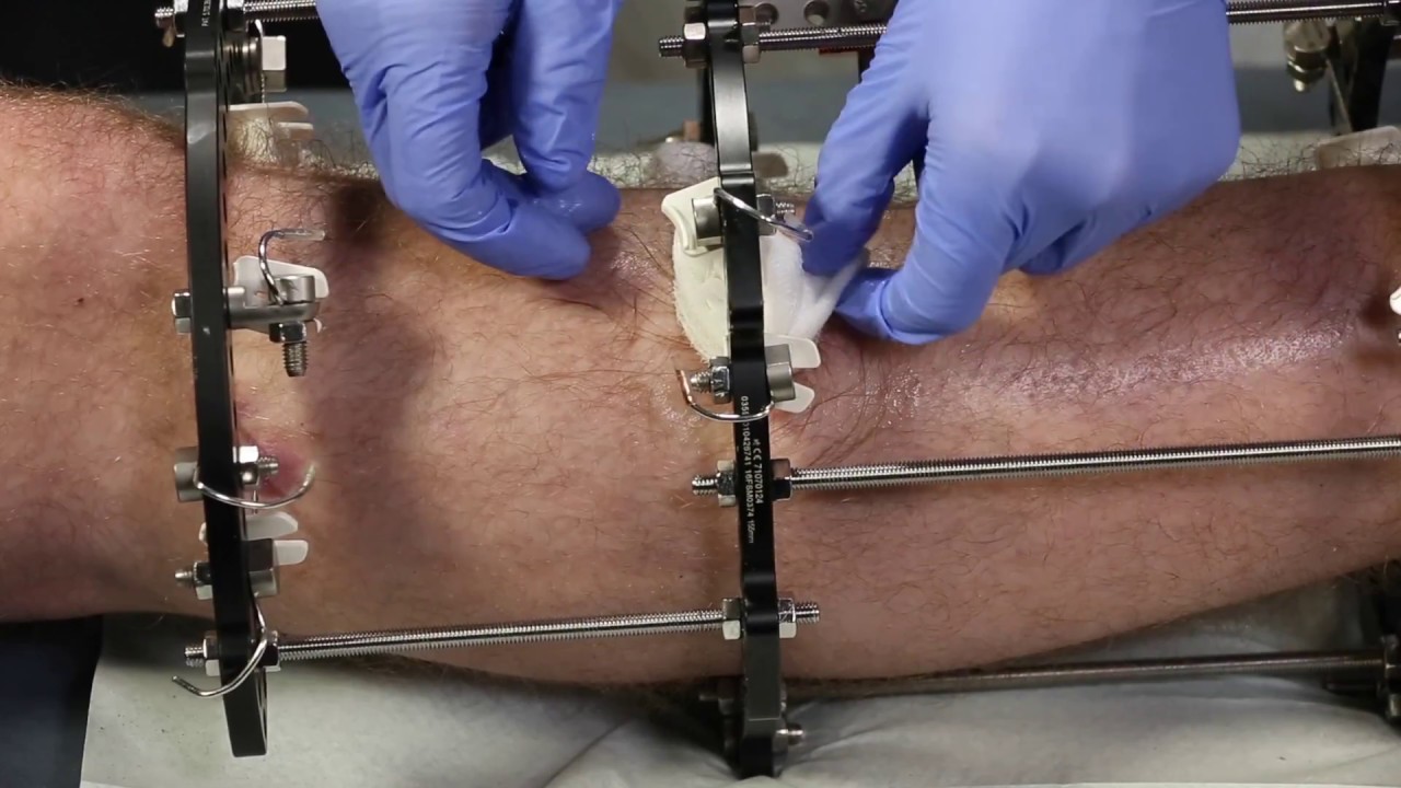 NHSGGC - GRI Pin Site Dressings Guidance