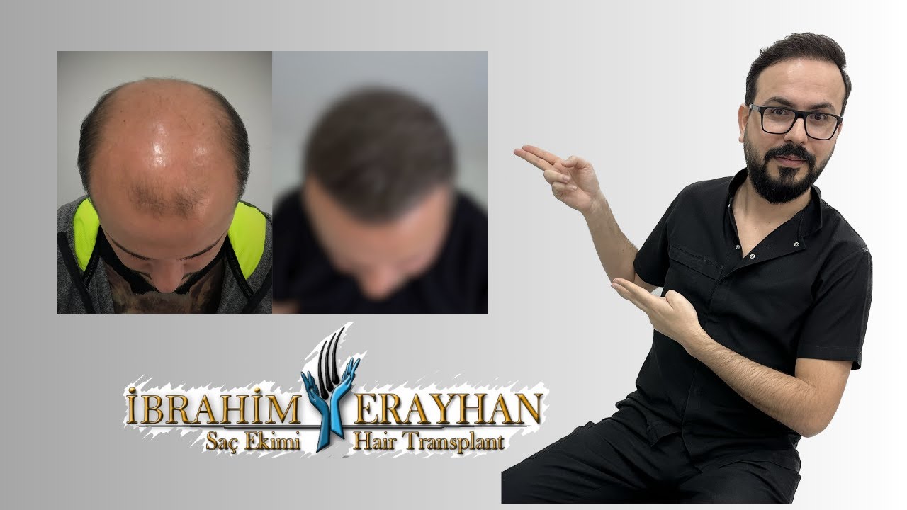 Büyük Saçsız Alan, Kısıtlı ve İnce Telli Donör ve Muhteşem Saç Ekim Sonucu