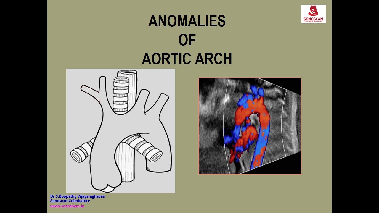 Fetal Echocardiography – Anomalies of Aortic Arch