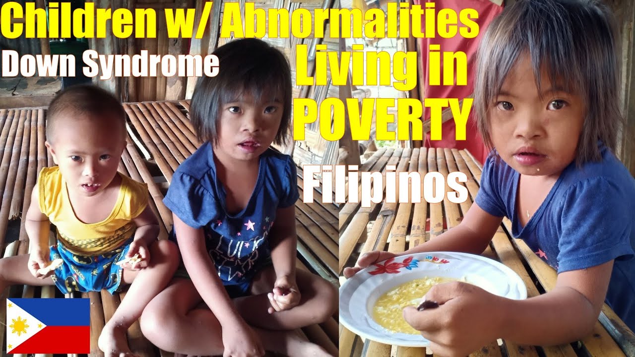 Filipino Children with Abnormalities Who Live in Extreme Poverty. Deep Poverty in the Philippines.